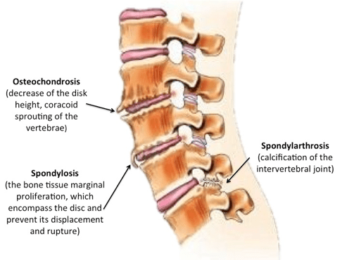 spondylosis osteochondrozis artrózisának kezelése