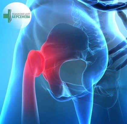 Arthrosis of the hip joints, causes, symptoms, treatment methods