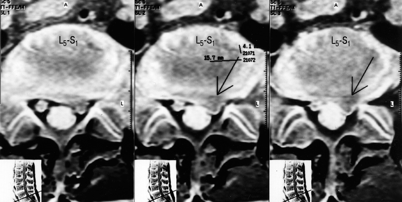 Грыжа l5 s1. Мрт грыжи л1с5. Дорзальная медиальная грыжа l5 s1.